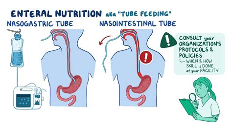 Enteral Tubes Guidelines: Gastrostomy Tubes Guidelines – LZBN
