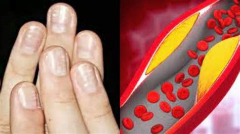 Cholesterol Warning Sign in Hands: নখ হলুদ হচ্ছে? হাতের ৩ সঙ্কেতই বলে ...