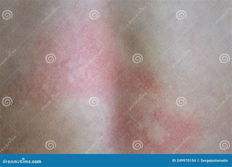 Urticaria On The Skin. Red Spots Of An Allergic Reaction On The Skin Of A Child. Urticaria ...