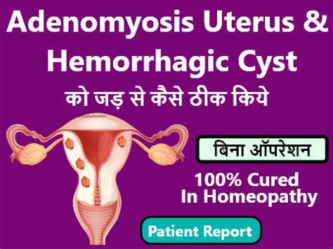 Hemorrhagic Ovarian CYST Treatment In Homeopathy