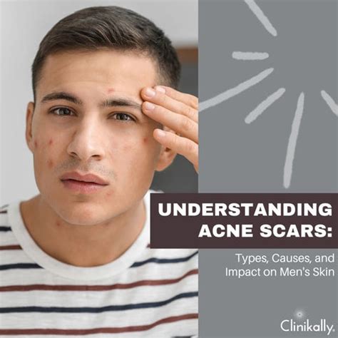 Top Acne Scar Treatments for Men: Clear Skin Guide | Clinikally