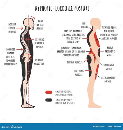 Kyphotic Lordotic Posture. the Side View Shows Deformation of Rounded ...