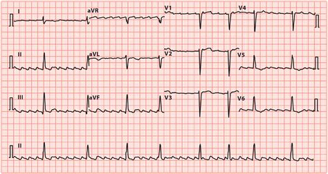 Atrial Flutter