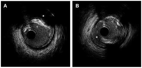 Novel Imaging-Based Biomarkers for Identifying Carotid Plaque Vulnerability