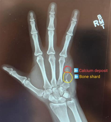 5th metatarsal fracture: swollen foot after work : r/brokenbones