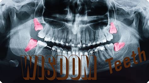 Can Wisdom Teeth Cause Headaches? Learn the Connection