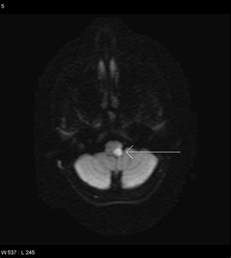 FULL TEXT - Lateral medullary syndrome post-chiropractic manipulation in a 25-year old female ...