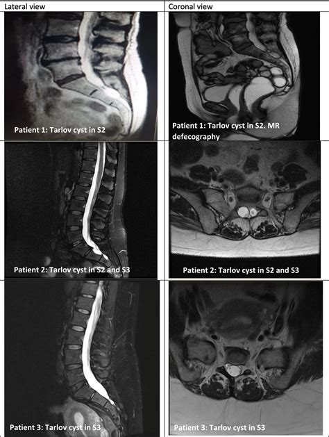 Symptomatic Tarlov cysts: A case series and effectiveness of multimodal rehabilitation plus ...