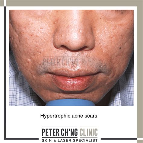 Hypertrophic Acne Scars