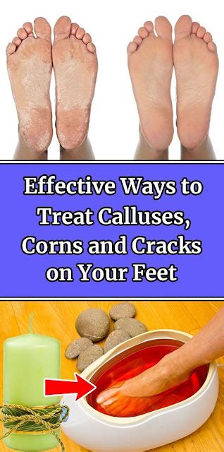 Image result for How to Remove Calluses From Feet Fast