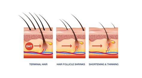 Understand Baldness Causes and Solutions - Avimee Herbal