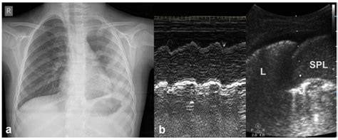 Lung Ultrasound in Pediatrics: A Review with Core Principles That Every ...