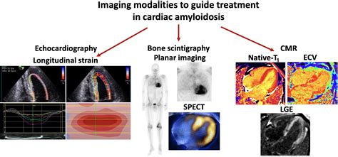 Monitoring cardiac amyloidosis with multimodality imaging - Revista ...