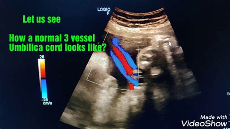 Bildergebnis für 2 vessel umbilical cord ultrasound