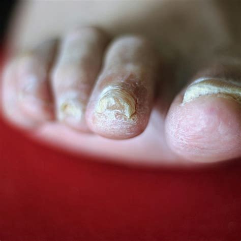 vicks toenail fungus results - Toenail Fungus Treatment | Toenail Fungus Treatment