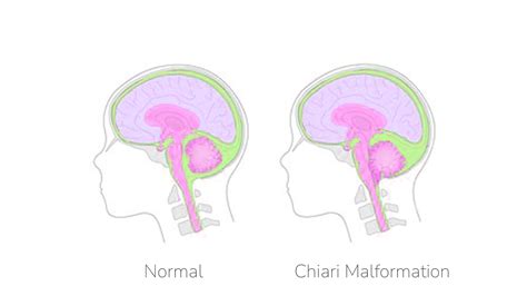 Chiari Malformation: Causes, Symptoms, and Treatment Options | Meri Sehat