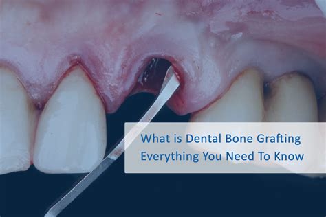 What is Dental Bone Grafting: Everything You Need To Know | Wellness ...