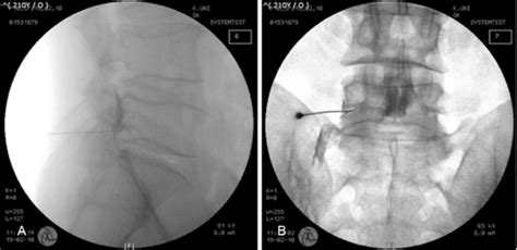 Image result for Selective Nerve Root Block vs Transforaminal