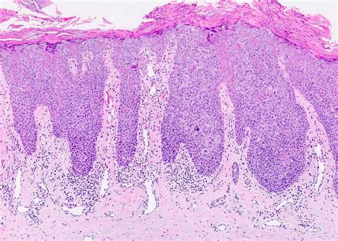 Pathology Outlines Squamous Cell Carcinoma Scc Squamous Cell Carcinoma