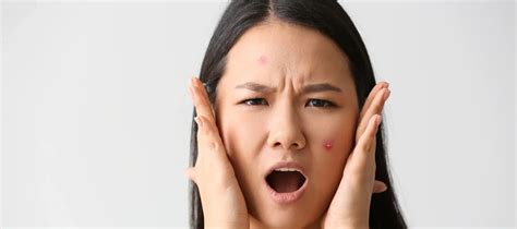 How Pimples Are Formed On The Face: A Guide To Pimple Formation - The ...