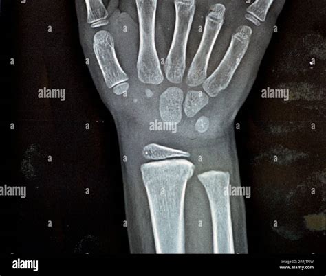 R Wrist X Ray at Rae Johnson blog