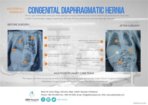 Congenital Diaphragmatic Hernia Repair