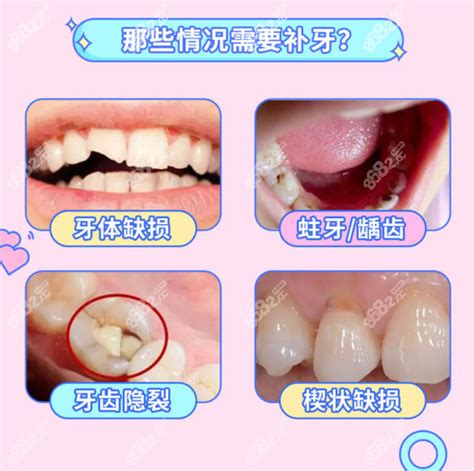 邛崃牙科收费标准，含邛崃补牙、牙齿矫正、拔智齿的价格,牙齿对比照片-8682赴韩整形网