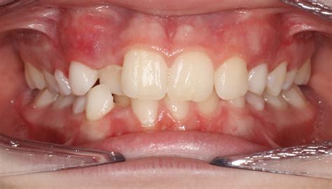 Image result for Crossbite Treatment Options