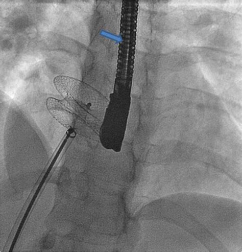 Pediatric Cardiology : Atrial Septic Defect : Atrial Septic Defect ...