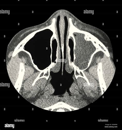 Sinus infection. Computed tomography (CT) scan of a section through the ...