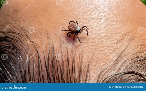 Image result for Embedded Deer Tick