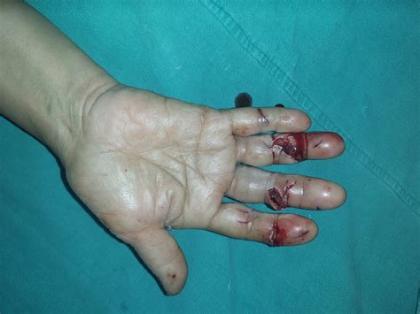 Hand Fracture Treatment in Lucknow | Kayakriti