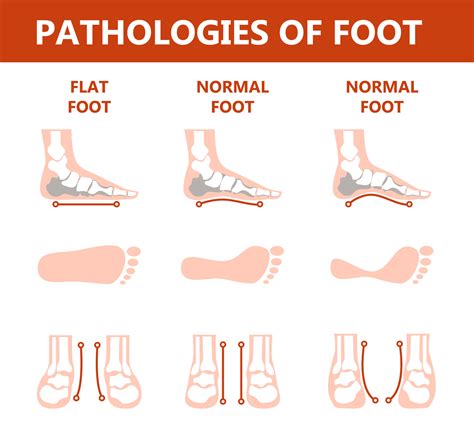 Flat Foot Problems Pain
