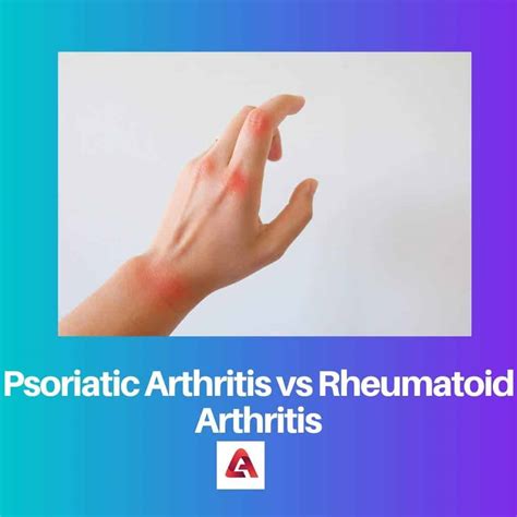 Psoriatic vs Rheumatoid Arthritis: Difference and Comparison