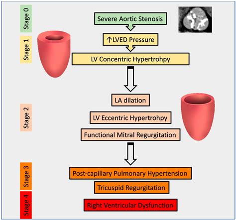 Beyond Aortic Stenosis: Addressing the Challenges of Multivalvular ...