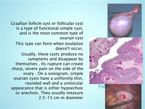Benign diseases of the ovary | PPTX