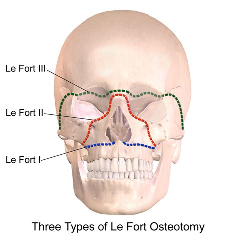Maxillofacial Trauma - emDocs