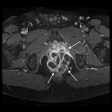 Perirectal / Perianal Abscess - Gastrointestinal - Medbullets Step 2/3