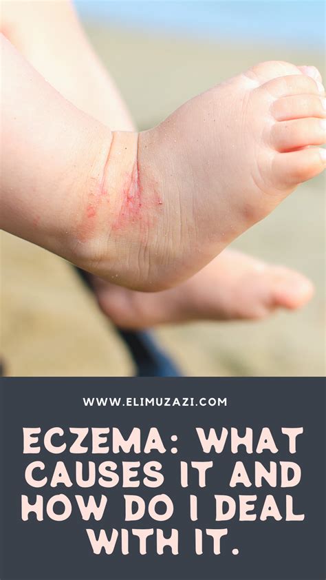 Eczema Causes Arthritis at Thelma Guerrero blog