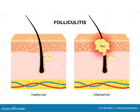 Hair Follicle Sore at Mason Duckworth blog