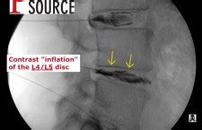 Image result for Lumbar Discogram