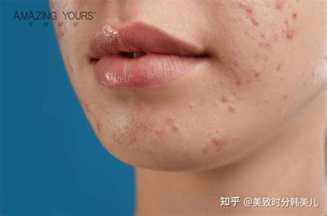 【图】嘴巴上面长痘的原因是什么 5大祛痘方法介绍(3)_嘴巴上面长痘的原因_伊秀美容网|yxlady.com