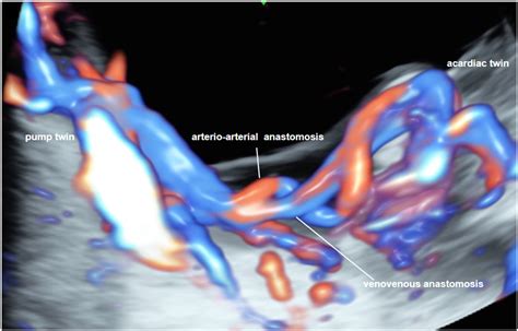 Twin reversed arterial perfusion sequence with a cardiac loop ...