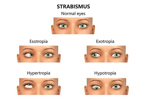 Strabismus surgery - Southside Eye Centre