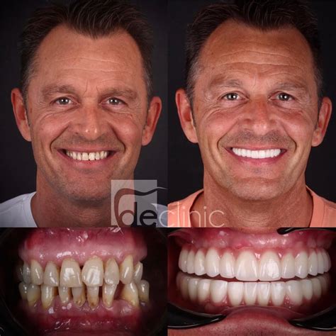 Tooth Implant Before After