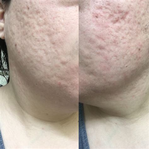 Cystic Acne Scars Treatment