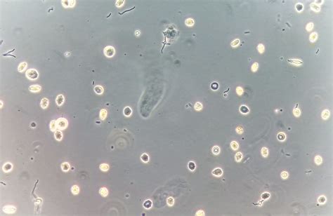 urinalysis bacteria abnormal