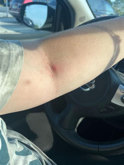 Image result for Hair Splinter Infection