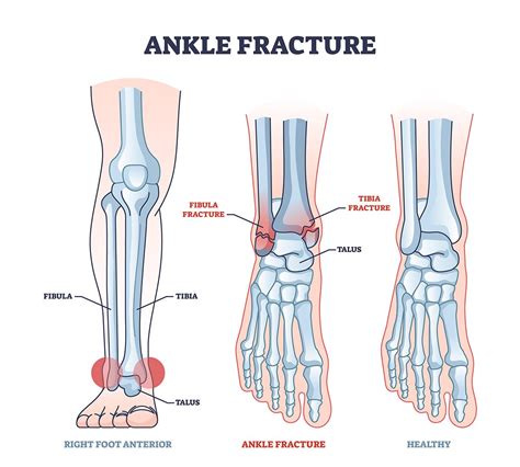 Ankle Fractures - Orthopedic Institute