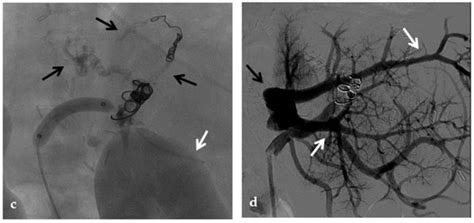 The Role of Imaging in Portal Vein Thrombosis: From the Diagnosis to ...